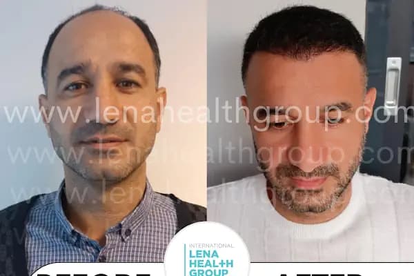 Lena Health Hairtransplant Turkey - Saç Transplantasyonu Kliniği - İzmir Bayraklı
