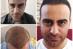 Gaziantep Hair Center(Gaziantep Saç Ekim Merkezi)