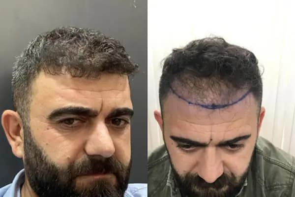 Güneydoğu Saç Ekimi - Saç Transplantasyonu Kliniği - Diyarbakır Bağlar