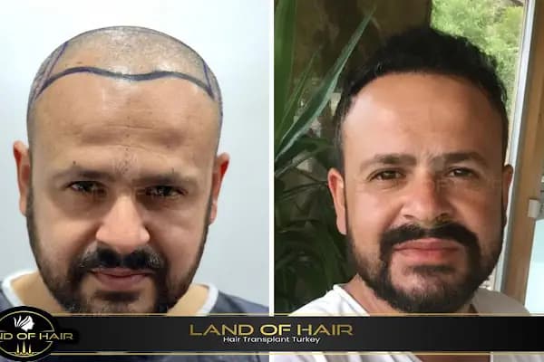 Land Of Hair - Hair Transplant Center / Istanbul Hair Transplant Center in Turkey - Saç Transplantasyonu Kliniği - İstanbul Ataşehir