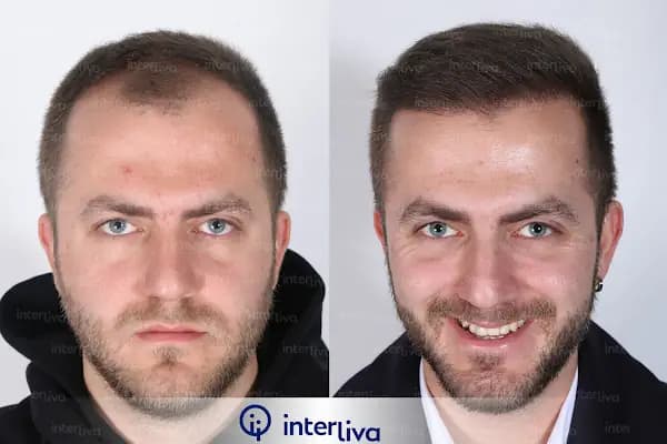 Aziz Aksöz - Hair Transplant Turkey,Hair Transplant İstanbul - Saç Transplantasyonu Kliniği - İstanbul Ümraniye