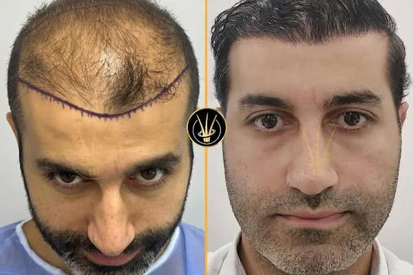 Real Of Hair - Hair Transplant Center in Turkey - Saç Transplantasyonu Kliniği - İstanbul Beyoğlu