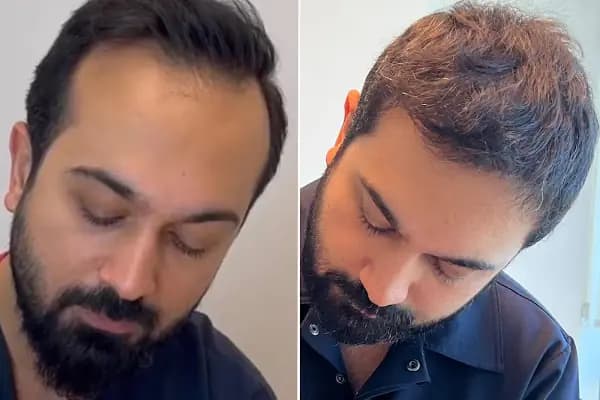 Dr.Gökeşme Hair Transplant - Saç Yenileme Hizmeti - İstanbul Bağcılar