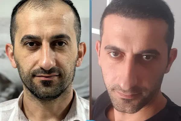 Esteweal Hair Clinic Saç Ekimi - Saç Transplantasyonu Kliniği - İstanbul Zeytinburnu