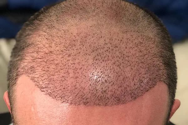 Ser Hair Center - Saç Transplantasyonu Kliniği - Ankara Altındağ