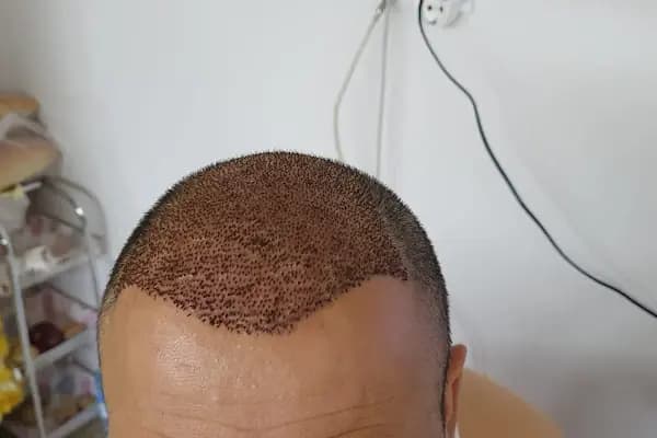 After Hair - Protez Saç Merkezi - Saç Ekim Kliniği - Saç Transplantasyonu Kliniği - Ankara Sincan