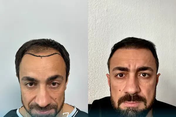 Vialux Hair Transplant | Ankara Saç Ekimi - Saç Transplantasyonu Kliniği - Ankara Yenimahalle