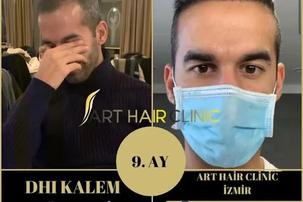 Art Hair Clinic Saç Ekim Merkezi İzmir - En iyi saç ekim merkezi İzmir - Saç Transplantasyonu Kliniği - İzmir Bayraklı