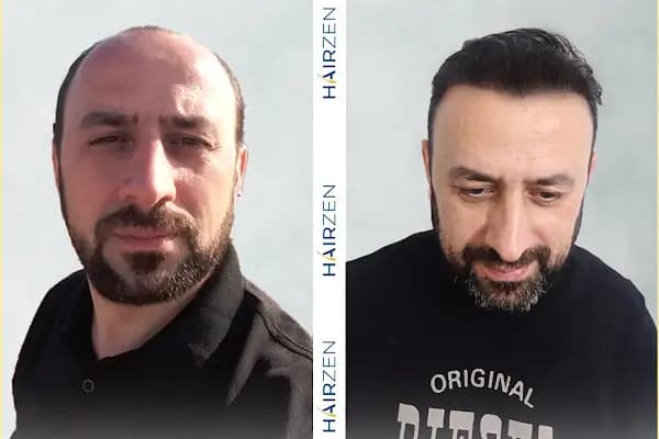 Hairzen Clinic - Saç Transplantasyonu Kliniği - İstanbul Beşiktaş