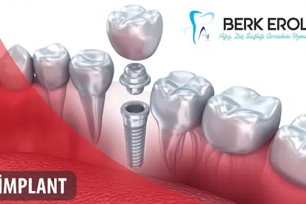 Uzm.Dr. Berk EROL | Çene Cerrahisi ve İmplant Kliniği - Diş Hekimi - İzmir Karabağlar