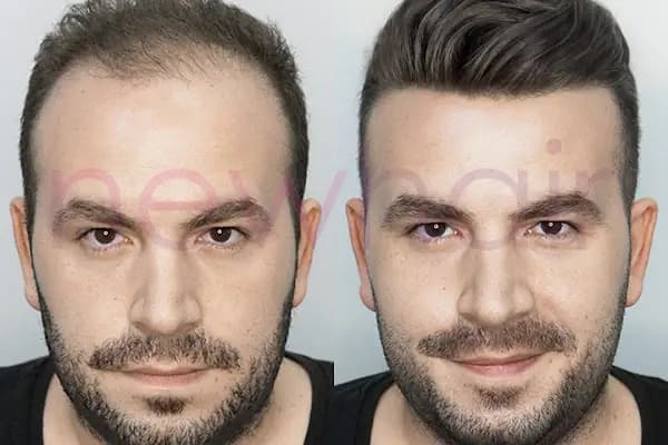 Newhair Bakırköy, Protez saç, Saç Protezi, Saç Ekimi, Kemoterapi, Hair Replacement, Toupee - Saç Yenileme Hizmeti - İstanbul Ataşehir