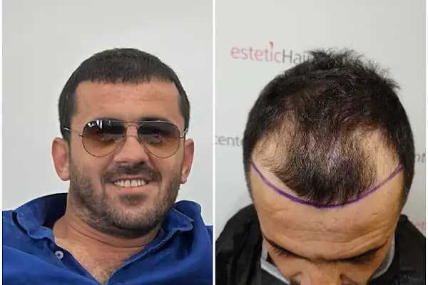 Estetichaircenter Saç Ekimi Saç Simülasyonu Bursa - Saç Transplantasyonu Kliniği - Bursa Osmangazi