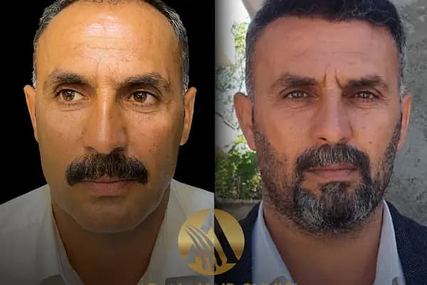 Simya Saç Ekimi &amp; Güzellik Merkezi - Hair Transplant Clinic in Turkey - Saç Transplantasyonu Kliniği - Adana Karaisalı