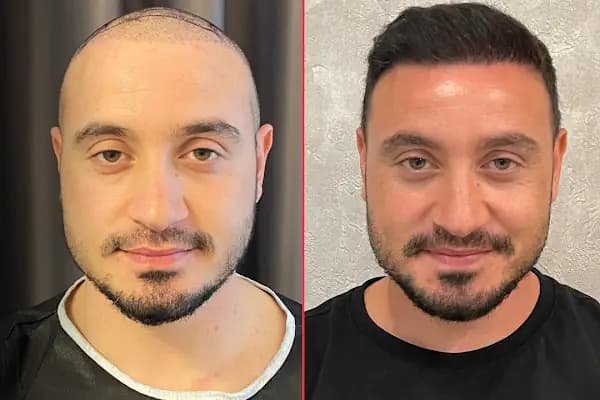 Cüneyt Arman - Saç Ekimi Ve Tedavileri - Saç Transplantasyonu Kliniği - İstanbul Güngören