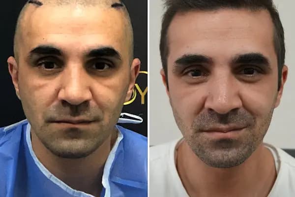 Trabzon Saç Ekim Merkezi Saç PRP`si | Altınsoy Hair Clinic - Saç Transplantasyonu Kliniği - Trabzon Maçka