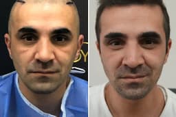 Trabzon Saç Ekim Merkezi Saç PRP`si | Altınsoy Hair Clinic