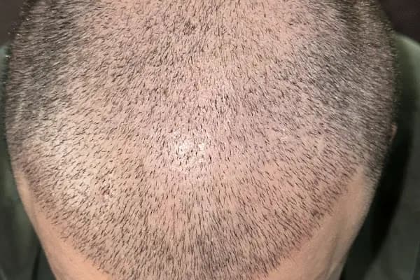 Saç Ekimi - Hair Transplant - Saç Transplantasyonu Kliniği - İstanbul Adalar