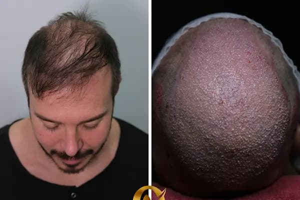 AVRUPA SAÇ EKİMİ - AVRUPA HAİR TRANSPLANT.|Greffe de Cheveux Turquie | Trasplante Capilar Turquia | Пересадка Волос в Турции - Saç Transplantasyonu Kliniği - İstanbul Şişli