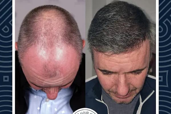 Smile Clinic - Saç Transplantasyonu Kliniği - İstanbul Şişli