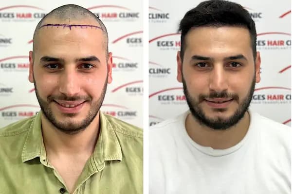 Bayraklı Saç Ekim Merkezi - İzmir Eges Hair Transplant - Güzellik Salonu - İzmir Karabağlar
