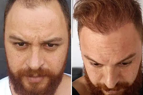 Erzurum Saç Ekim Merkezi Saç PRP`si | Altınsoy Hair Clinic - Estetik Cerrahi Kliniği - Erzurum Yakutiye