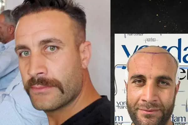 yordam hair saç ekim - Saç Transplantasyonu Kliniği - Gaziantep Şehitkamil