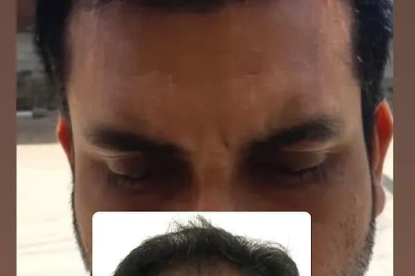İzmir Saç Ekimi | İzmir Hair Transplantation | Serena Polikliniği | İzmir Kaş Ekimi - Saç Transplantasyonu Kliniği - İzmir Balçova