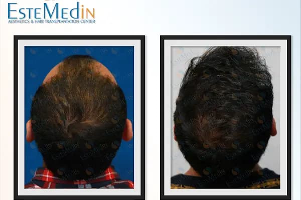EMPCLINICS Emphair Hair Transplant, Aesthetic Plastic Surgery, Dental Treatments, Men's Health - Estetik Cerrahi Kliniği - İstanbul Ataşehir