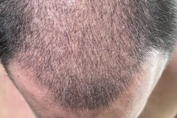 DK Klinik (Dermatology and Hair Transplant Antalya) - Dermatolog - Antalya Elmalı