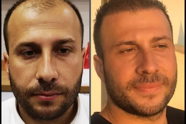 Esste Moda Hair - Saç Transplantasyonu Kliniği - Adana Çukurova