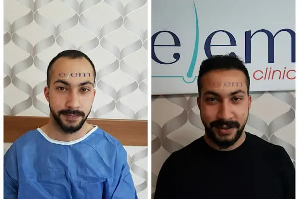 Gaziantep Saç Ekim&amp;Protez - Fue Estetik - Estetik Cerrah - Gaziantep Şehitkamil