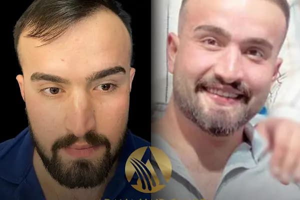 Adana Hair Clinic - Hair Transplant in Adana - Saç Transplantasyonu Kliniği - Adana Çukurova