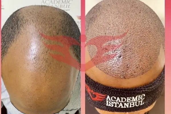 Academic İstanbul Saç Ekim - Resim 18