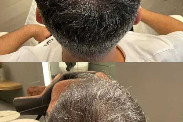 S Clinic Antalya - Saç Çoğaltma, Saç Bakım ve Güzellik Merkezi - Resim 7