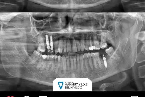 Özel Mimoza Ağız ve Diş Sağlığı Polikliniği ve İmplant Diş Merkezi - Resim 19