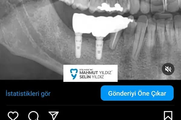 Özel Mimoza Ağız ve Diş Sağlığı Polikliniği ve İmplant Diş Merkezi - Resim 11