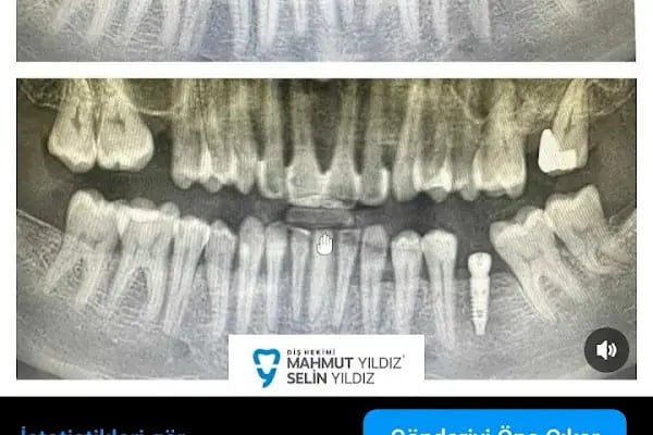 Özel Mimoza Ağız ve Diş Sağlığı Polikliniği ve İmplant Diş Merkezi - Resim 12