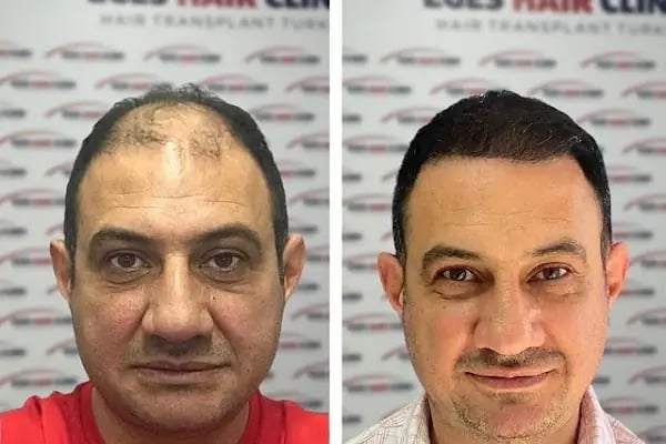 Aydın Saç Ekim Merkezi Eges Hair Transplant Clinic - Resim 14