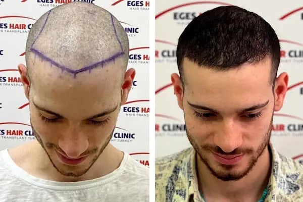 Aydın Saç Ekim Merkezi Eges Hair Transplant Clinic - Resim 8