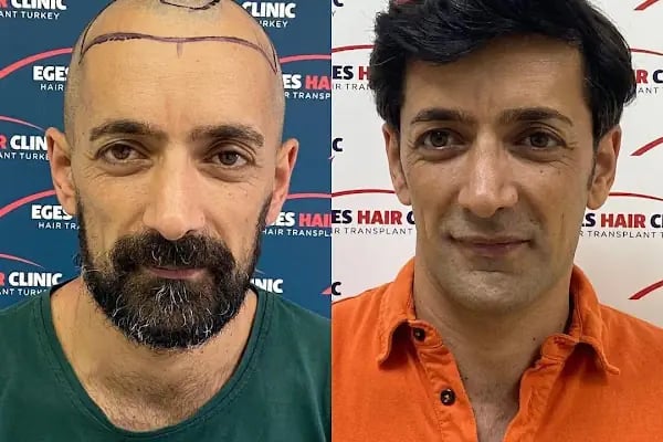 Aydın Saç Ekim Merkezi Eges Hair Transplant Clinic - Resim 13