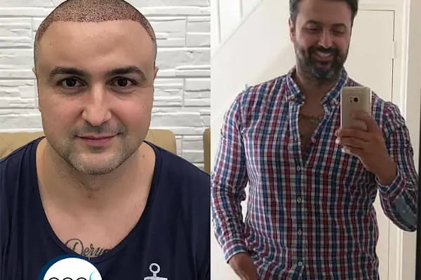 Aydın Saç Ekim Merkezi Eges Hair Transplant Clinic - Resim 7