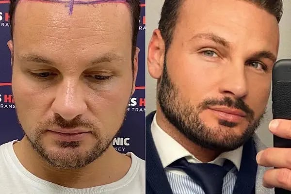 Aydın Saç Ekim Merkezi Eges Hair Transplant Clinic - Resim 11