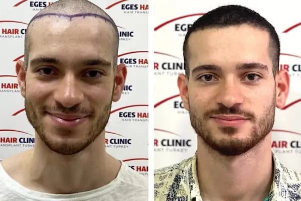 Aydın Saç Ekim Merkezi Eges Hair Transplant Clinic - Resim 20