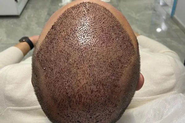 Aydın Saç Ekim Merkezi Eges Hair Transplant Clinic - Resim 2