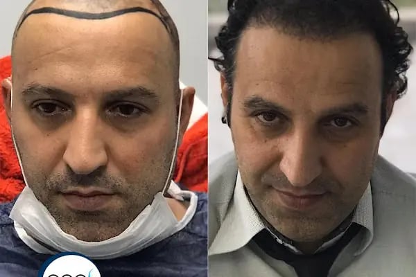 Aydın Saç Ekim Merkezi Eges Hair Transplant Clinic - Resim 9