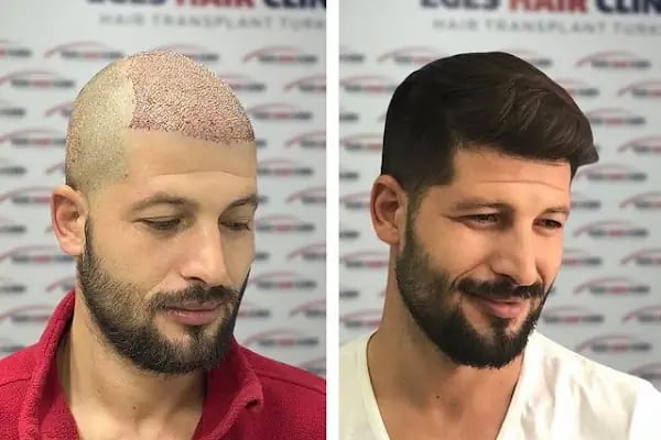 Aydın Saç Ekim Merkezi Eges Hair Transplant Clinic - Resim 10