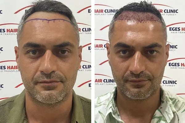 Aydın Saç Ekim Merkezi Eges Hair Transplant Clinic - Resim 17