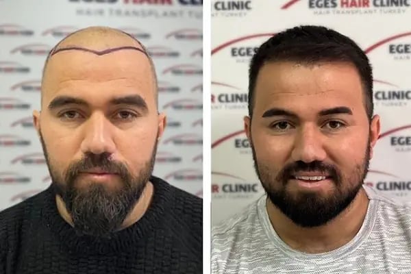 Aydın Saç Ekim Merkezi Eges Hair Transplant Clinic - Resim 12