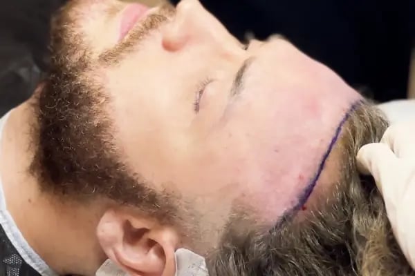 Implant World Hair -BEST HAIR TRANSPLANT CLINIC TURKEY - Resim 1