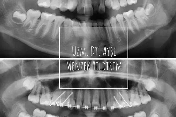 Uzm. Dt. Ayşe Menzek Yıldırım Ortodonti Kliniği, Konya Ortodonti Uzmanı, Şeffaf Plak Tedavisi, Diş Teli Uygulaması - Resim 17